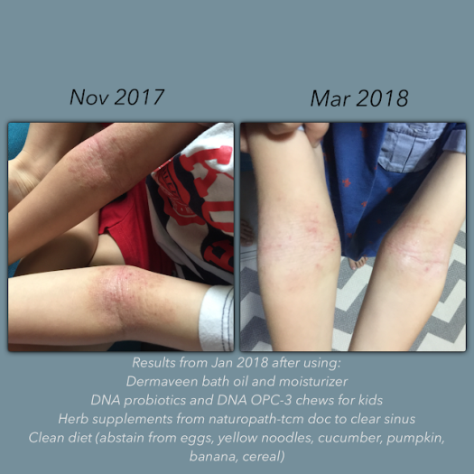 zephy's eczema improvement